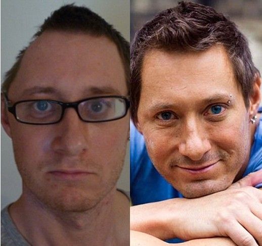 半头人接受面容创伤手术恢复英俊容貌图