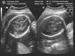 怀孕37天b超孕囊图图片