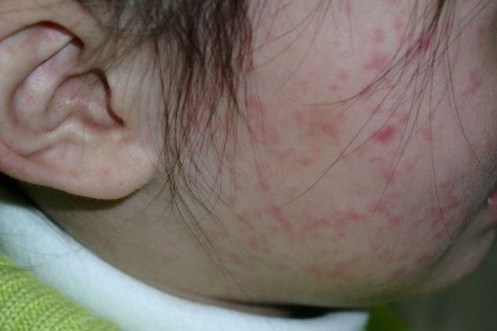小孩起麻疹的症状图片图片