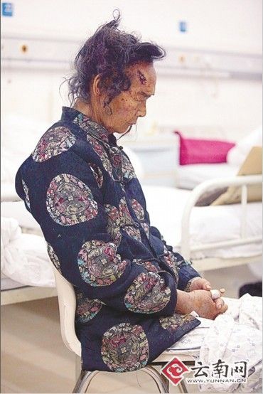 独居大爷跌倒摔伤 邻居大妈扶起送医