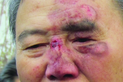 鼻窦炎引起的脸肿图图片