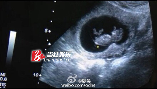 怀孕怀女孩器官B超图图片
