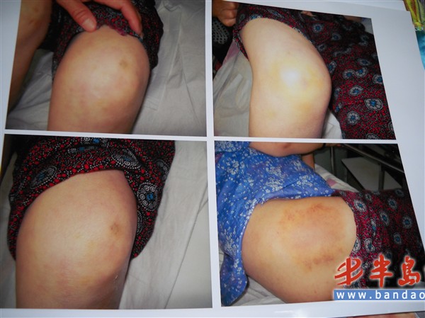 老人敬老院内摔成脑出血 家属院方各执一词