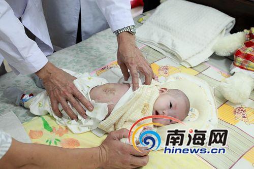 广州中山大学附属第一医院外科主治医生刘钧澄查看双胞胎姐妹薛云