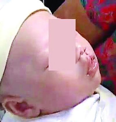 兔唇宝宝.b超显示"上唇线连续".