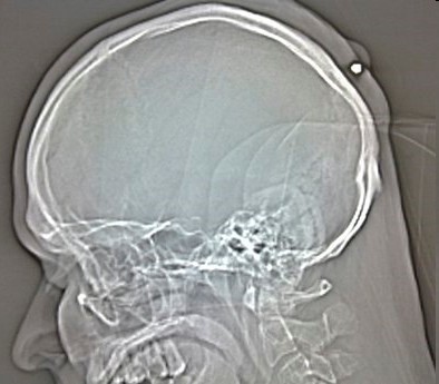 波兰男子头部中枪5年后才被发现图