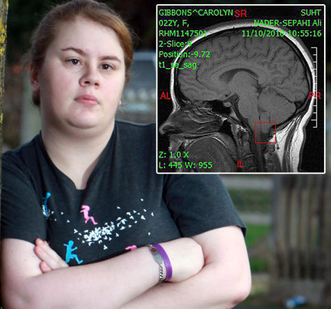 英国一女教师脑畸形 大笑恐导致头部"爆炸"而死(图)