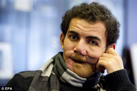 利比亚男子半边脸被炸裂 多次整形终能开口(图)