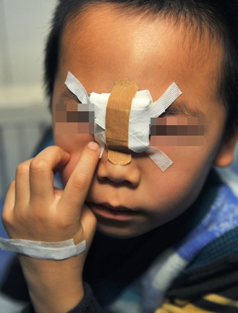 他的鼻梁处被铁锨砍出一道长约两厘米的伤口,医生已进行缝合,包扎处理