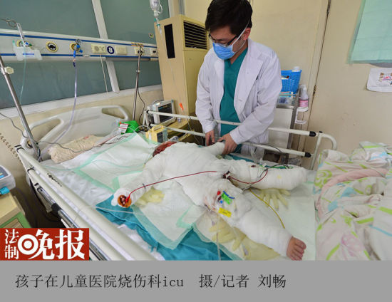 2岁儿童坐进面汤桶 全身95%面积烫伤(图)