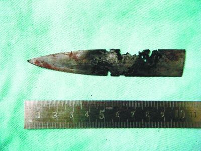 男子治疗口腔疾病发现脑中残留断刀图