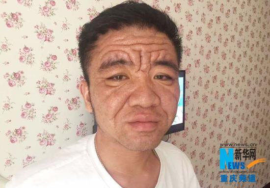 重庆小伙长出一张"老脸" 满脸皱纹似80岁老头