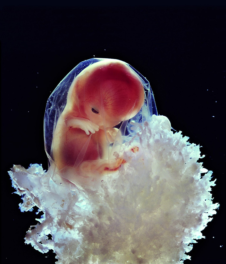 胎儿畸形图片真实图片