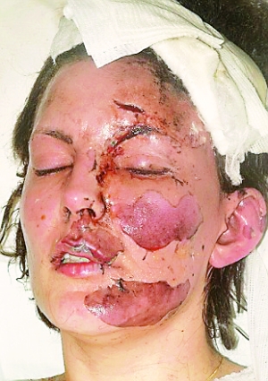 图莱尔在爆炸中脸部受伤相当严重,幸运的是后来完全康复.