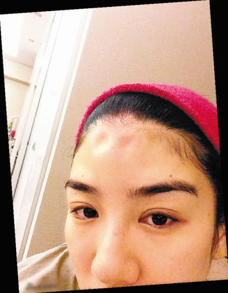 黄奕额头上的两个坑成为网友讨论焦点