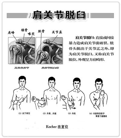 肩关节复位方法图片
