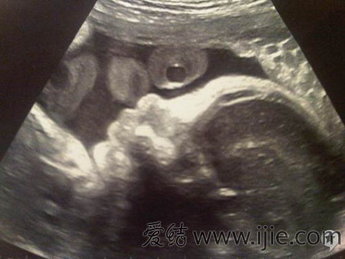怀孕40天b超图片男孩图片
