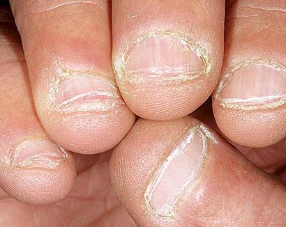 指甲不美观 预示各类身体疾病(组图)(3)