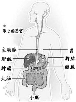 美國63歲老太 掏空腹腔切腫瘤(組圖)(2)_新浪女性_新浪網